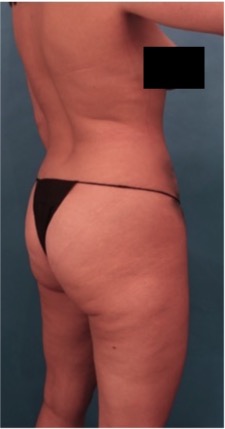 Brazilian Butt Lift Patient #2 Before Photo # 5