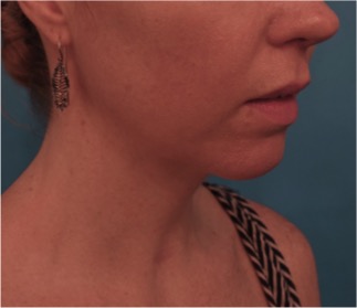 After Image: Kybella Patient #10 -