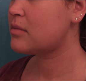 Kybella Patient #14 After Photo # 6