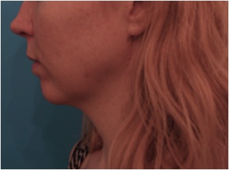Before Image: Kybella Patient #10 -