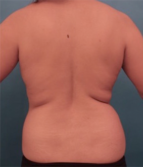 Liposuction Patient