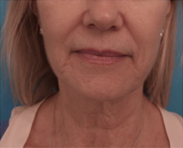 Kybella Patient