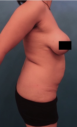 Abdominoplasty/ Tummy Tuck Patient #10 Before Photo # 11