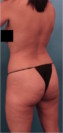 Brazilian Butt Lift Patient #2 Before Photo Thumbnail # 7