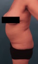 Abdominoplasty/ Tummy Tuck Patient #10 Before Photo Thumbnail # 5