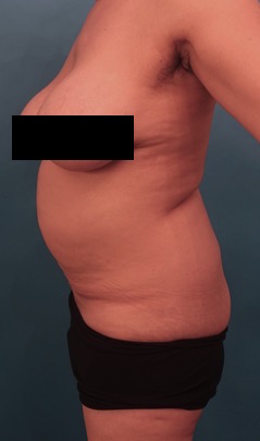 Abdominoplasty/ Tummy Tuck Patient #10 Before Photo # 5