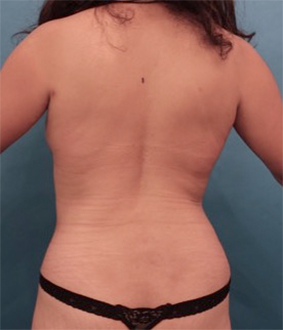 Liposuction Patient