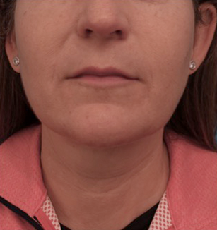 Kybella Patient #13 Before Photo # 1