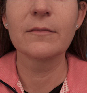 Kybella Patient