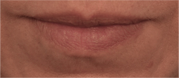 Lip Filler Patient #11 Before Photo # 1