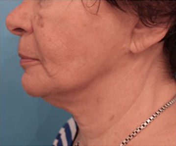 Kybella Patient #12 Before Photo # 5