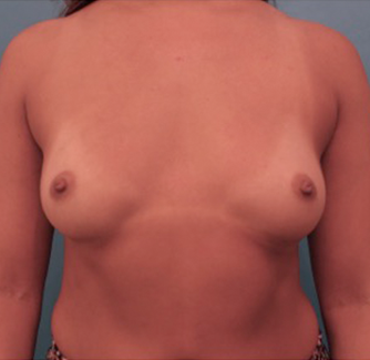 Breast Augmentation (Implants) Patient #6 Before Photo # 1