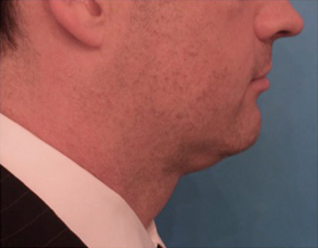 After Image: Kybella Patient #11 -