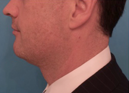 After Image: Kybella Patient #11 -