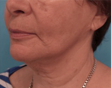 Kybella Patient #12 Before Photo # 3