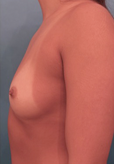 Breast Augmentation (Implants) Patient #6 Before Photo # 3