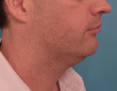 Male Kybella Patient #7 Before Photo # 7