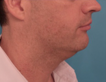 Before Image: Kybella Patient #11 -