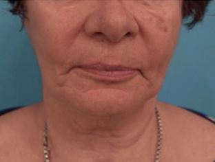 Kybella Patient #12 Before Photo # 1