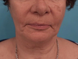 Kybella Patient