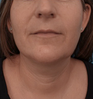 Kybella Patient #13 After Photo # 2