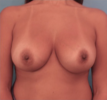 Breast Augmentation (Implants) Patient #5 After Photo # 2