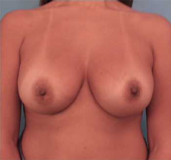 Breast Augmentation (Implants) Patient