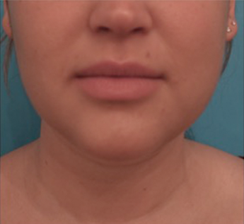 Kybella Patient