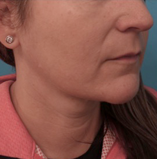 Kybella Patient #13 Before Photo # 3