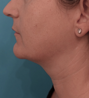 Kybella Patient #13 After Photo Thumbnail # 8