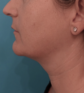 Kybella Patient #13 After Photo # 8