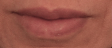 Lip Filler Patient #11 After Photo Thumbnail # 2