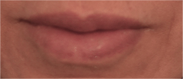 Lip Filler Patient #11 After Photo # 2