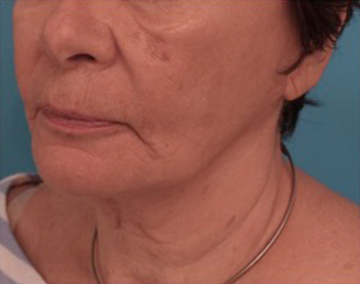 Kybella Patient #12 After Photo # 4