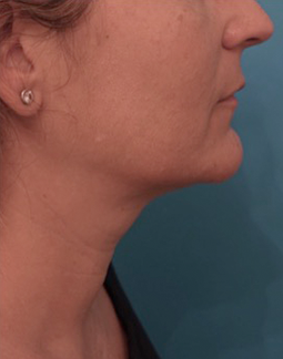 Kybella Patient #13 After Photo Thumbnail # 6