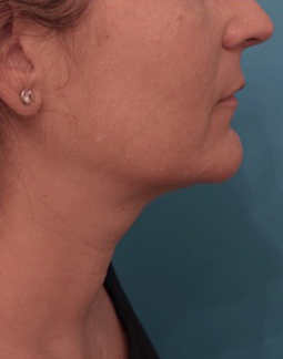 Kybella Patient #13 After Photo # 6