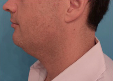 Before Image: Kybella Patient #11 -