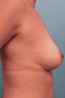 Breast Augmentation (Implants) Patient #5 Before Photo # 9