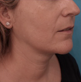 Kybella Patient #13 After Photo Thumbnail # 4