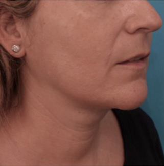 Kybella Patient #13 After Photo # 4