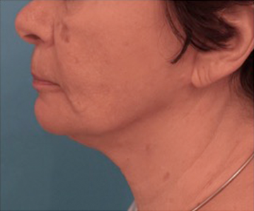 Kybella Patient #12 After Photo # 6