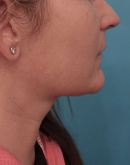 Kybella Patient #13 Before Photo # 5