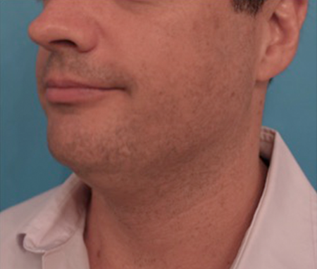 Before Image: Kybella Patient #11 -