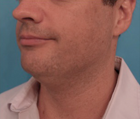 Kybella Patient #11 Before Photo # 3