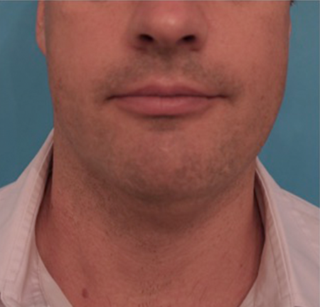 Kybella Patient #11 Before Photo # 1