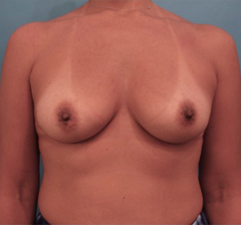 Breast Augmentation (Implants) Patient #5 Before Photo # 1