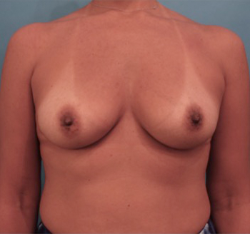 Breast Augmentation (Implants) Patient