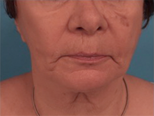 Kybella Patient #12 After Photo # 2