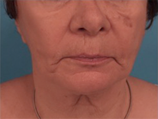 Kybella Patient