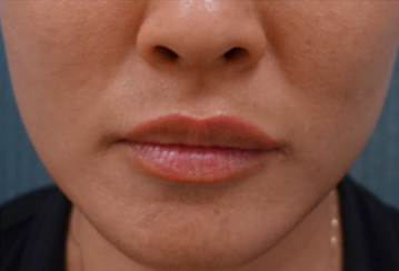 Lip Filler Patient #10 After Photo # 2